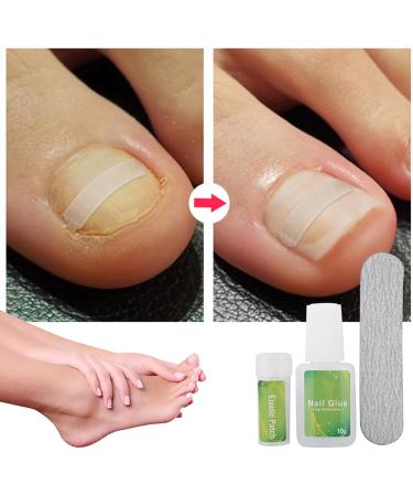 Ingrown Toenail Patch Ingrown Toenail Corrector Toenail Correction Patch Glue Toenail Patch with Elastic Gasket for Women Men Ingrown Toenail Kit (12 Pieces) - Buy Online on SooperMarket.com