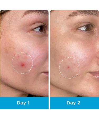 LitBear Pimple Patches | Invisible Hydrocolloid Acne Treatment | 66 Assorted Salicylic Acid Spot Covers for Whiteheads & Cystic Acne - Buy Online on SooperMarket.com
