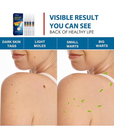 Extra Strength Skin Tag Remover | Wart Removal | Tag Dries and Falls Away | Natural Ingredients | All Skin Types - Buy Online on SooperMarket.com