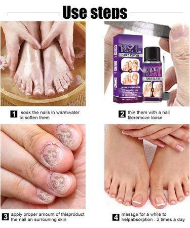 Fungal Nail Treatment 30ml Extra Strong Nail Fungus Treatment for Toenail and Fingernail Premium Fungal Nail Eliminator Anti fungus Nail Repair and Strengthen Fix & Renew Damaged Broken Nails - Buy Online on SooperMarket.com