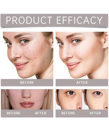 Niacinamide 10% + Zinc 1% Face Serum 10% Niacinamide Serum Niacinamide Spots Removal Serum Brightening Serum Tackles Blemishes Minimises Pore Softens and Moisturizes Skin Evens Skin Tone - Buy Online on SooperMarket.com