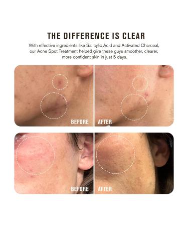 Every Man Jack Acne Spot Treatment - Maximum Strength Skin Clearing Serum with 2% Salicylic Acid & Activated Charcoal - Target Acne Blemishes & Redness - Fast Absorbing 0.5oz (Pack of 1 - Buy Online on SooperMarket.com