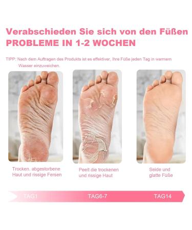 Buy SDSM Foot Mask for Hard Skin - 2 Pairs of Peeling Socks for Dead Skin & Cracked Heels - Plant-Based Moisturizing Formula for Baby Soft Feet (Rose) - International Shipping Available - Buy Online on SooperMarket.com