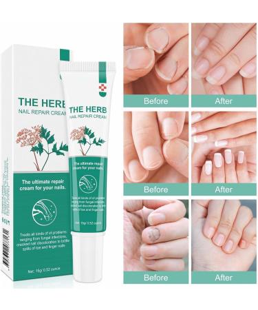 Nail Repair Cream Effective Fungal Nail Treatment for Toenails Fungus Nail Cream Nourishing For Restores Discolored & Damaged Strong Nail Fungus Treatment for Toenail Restores Healthy Appearance - Buy Online on SooperMarket.com