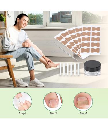 Ingrown Toenail Treatment Kit - 50 Pcs Patches, Corrector Strips, Nail Lifter | Professional & Painless Solution - Buy Online on SooperMarket.com