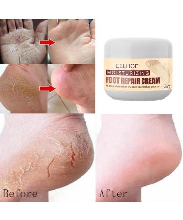 Vegan Foot Cream for Dry Rough & Cracked Feet | Best Callus Care - International Shipping - Buy Online on SooperMarket.com