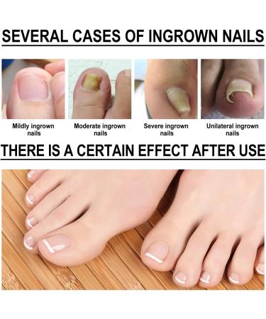 Ingrown Toenail Treatment - 30ml Ingrown Toenail - Cuticle Care Oils for Ingrown Toenails - Trimming Toenail Softening Drops Natural Ingrown Toenail Correction Treatment Fungal Nail Treatment - Buy Online on SooperMarket.com