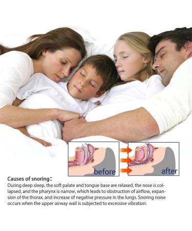 Anti Snoring Tape - Mouth Breathing & Snoring Solution | Nose Paste for Snoring Prevention - Blue One Size - Buy Online on SooperMarket.com