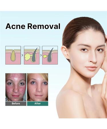CRusio Awzlove Ampoule Scar Removal Serum - Remove New Scars in 3 Weeks, Old Scars in 6 Weeks (1pcs) - Buy Online on SooperMarket.com