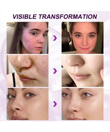 Marianp Hyaluronic Acid Serum & Azelaic Acid 10% for Acne Pigmentation & Rosacea - Vitamin B3 & B5 | Best Skincare Treatment - Buy Online on SooperMarket.com