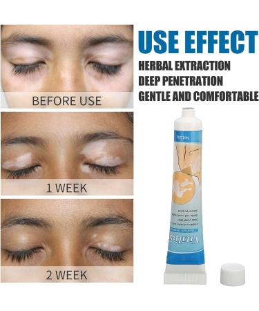 Vitiligo Cream 30G - Herbal Extract Treatment for White Spots & Skin Pigmentation - Creme Medix Leukoplakia Solution - 0.7oz - Buy Online on SooperMarket.com