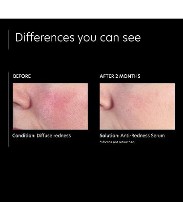 PCA SKIN Anti Redness Remover Face Serum - Calming Oil-Free Treatment for Irritation & Skin Tone - 1 fl oz - Buy Online on SooperMarket.com