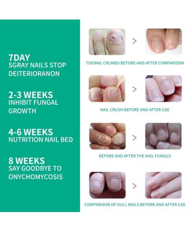 2Pack Kerassentials Toenail Oil and Skin Treatment Set for Nail Care - Buy Online on SooperMarket.com