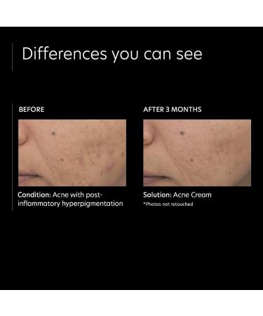 PCA SKIN Acne Treatment Cream - 5% Benzoyl Peroxide & Lactic Acid Spot Treatment for Acne-Prone Skin (0.5 oz) - Buy Online on SooperMarket.com