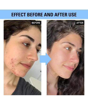 Trendyfave Glycolic Acid Serum Glycolic Acid Face Serum With Natural Plant Extract Face Care Serum Reduce Blemishes And Acne Exfoliate Glycolic Acid Toner Serum Korean Skincare 30ml - Buy Online on SooperMarket.com