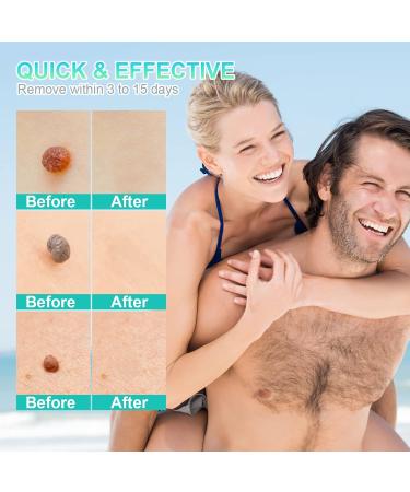 New Version Auto Skin Tag Remover Kit 2-Set Painless Skin Tag Removal Kit Tools for (1-9mm) Skin Tags (includes 100 Removal Bands & 36 Repair Patches & 20 Pcs Cleansing Wipes) Blue Green 2pcs Kit - Buy Online on SooperMarket.com
