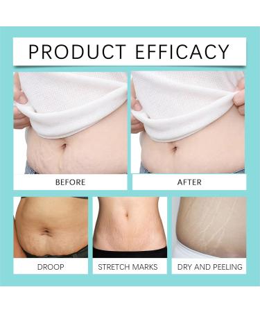 Stretch Mark Oil Collagen Skin Resilience Oil Stretch Mark Body Oil for Women Stretch Marks Removal Body Moisturiser Improve the Appearance of Scars Stretch Marks and Uneven Skin Tone - Buy Online on SooperMarket.com