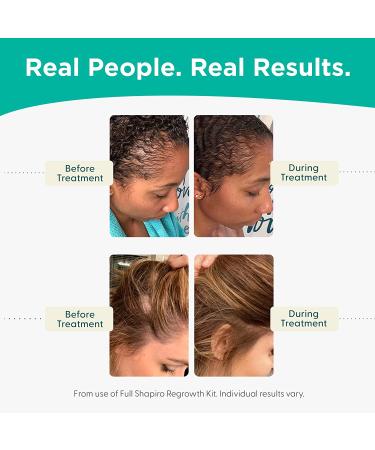 Minoxidil 2% Women's Hair Growth Serum | Promotes Hair Regrowth | Reactivates Hair Follicles | Shapiro MD - Buy Online on SooperMarket.com