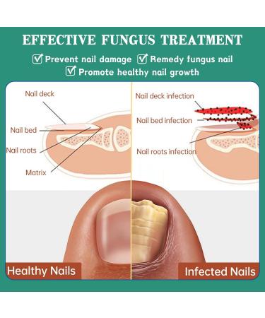 Nail Repair Cream Effective Fungal Nail Treatment for Toenails Fungus Nail Cream Nourishing For Restores Discolored & Damaged Strong Nail Fungus Treatment for Toenail Restores Healthy Appearance - Buy Online on SooperMarket.com