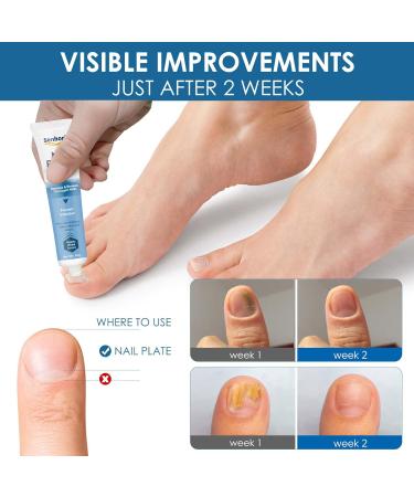 Extra Strength Toenail Fungus Treatment Cream for Thick, Broken, Discolored Nails - 1 Count - Buy Online on SooperMarket.com