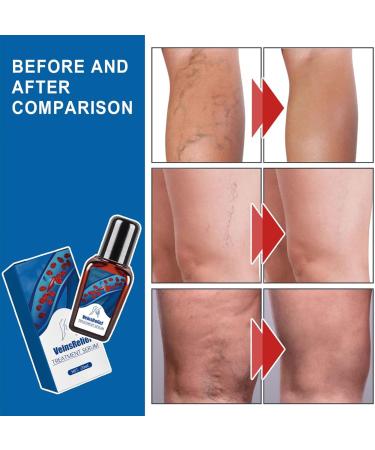 Varicose Vein Treatment Spray & Serum - 2 x 20ml for Spider Veins Relief | Effective Vein Care Cream - Buy Online on SooperMarket.com