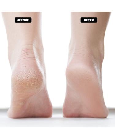 Nado Care 4 Pairs Heels Moisturizing Socks for Dry Cracked Heels Repair - Gel Heel Sleeves - Open Toe Comfy Socks - Pink Blue Grey Black - Buy Online on SooperMarket.com