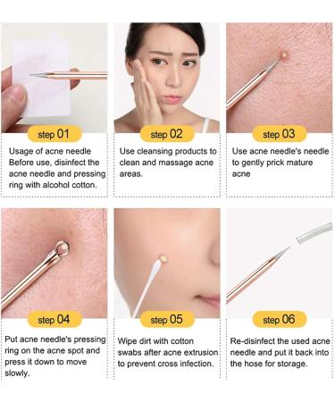 Blackhead Remover Pimple Popper Tool Kit - Professional Acne Extractor Set for Face & Nose - Blemish Whitehead Extraction Tools in Rose Gold Case - Buy Online on SooperMarket.com