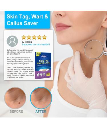 Skin Tag Remover Patches - 144Pcs | Safe & Painless Wart Removal for Face & Body - Buy Online on SooperMarket.com
