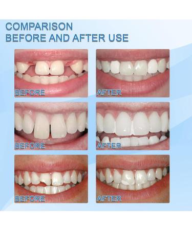 Flipped Warmth Provisional Dentures - 60g Heat Conductive Tooth Filling Pearls | Degradable Dental Repair Material for Missing & Broken Teeth - Buy Online on SooperMarket.com