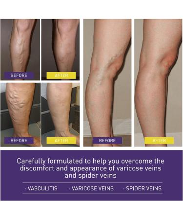 Varicose Vein & Spider Vein Cream | Capillary Health Treatment | Improve Circulation 0.7oz - Buy Online on SooperMarket.com