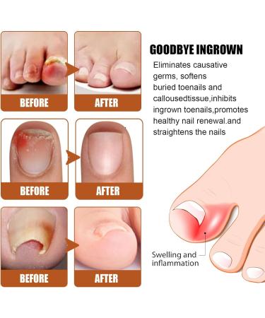 Ingrown Toenail Treatment and Removal Relief Oil - Nail Growth and Fungal Corrector - Buy Online on SooperMarket.com