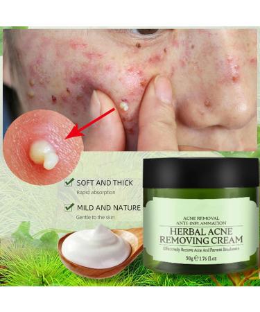 Acne Cream Moisturiser Face Cream Spot Cream Mens Moisturiser Tea Tree Cream Spot Cream For Acne Cream Moisturiser for Women Men Teenagers Dilute Face Prone Spot Marks Balance Facial Oil Cream - Buy Online on SooperMarket.com