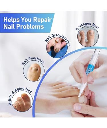 XIFEPFR Toenail Repair Pen - Nail Fingernail Repair Pen for Thick  Broken  Discolored Nails - Restores Healthy Strong Nails - 4PCS - Buy Online on SooperMarket.com