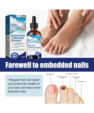 Ingrown Toenail Treatment - 30ML Ingrown Toenail Correction Drops - Nail Helper Ingrowth Toenail Treatment Oil - Trimming Toenail Softening Drops - Nail Fungal Treatment - Buy Online on SooperMarket.com