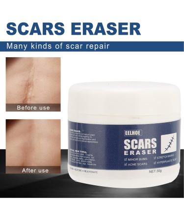Scar Gel - Skin Repair and Removal Treatment for Face, Body, Surgery, Burns, Stretch Marks - Buy Online on SooperMarket.com