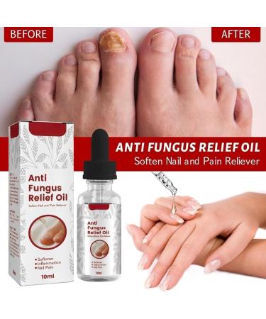 TBeautfave Fungal Nail Treatment Antifungal Nail Treatment Toe Nail Fungal Treatment Fungal Nail Treatment for Toenails Extra Strong Nail Repair and Strengthen Fix & Renew Damaged Broken Nails - Buy Online on SooperMarket.com
