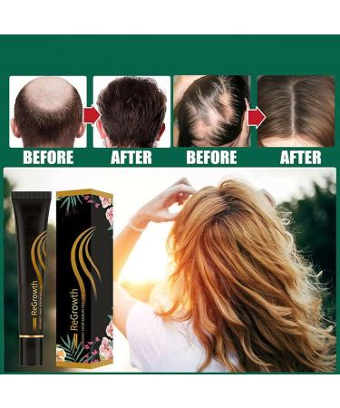 20ml Organic Hair Regrowth Serum Roller Set | Herbal Scalp Intense Roll-On for Men & Women | Triple Massager Hair Growth Essence (3PCs) - Buy Online on SooperMarket.com