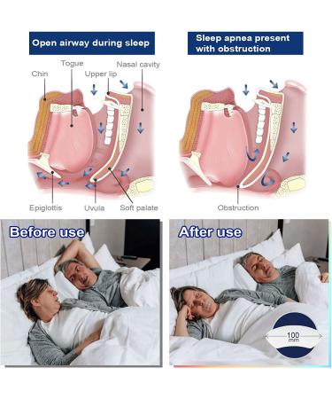 Sleep Mouth Strips - Gentle Nasal Breathing Aid for Better Sleep Quality - Reduce Mouth Breathing & Snoring (60pcs) - Buy Online on SooperMarket.com