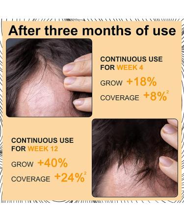 5% Minoxidil Foam Hair Regrowth Treatment for Men & Women - Stops Hair Loss, Promotes Follicle Growth - 2.11fl oz - Buy Online on SooperMarket.com
