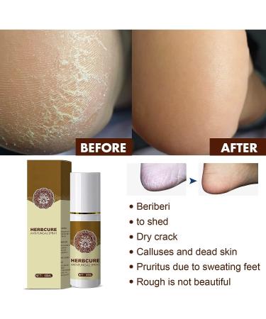 2 Pcs Athlete's Foot Spray Set - Foot Peeling & Odor Eliminator (60ml) | For Women & Men - Buy Online on SooperMarket.com