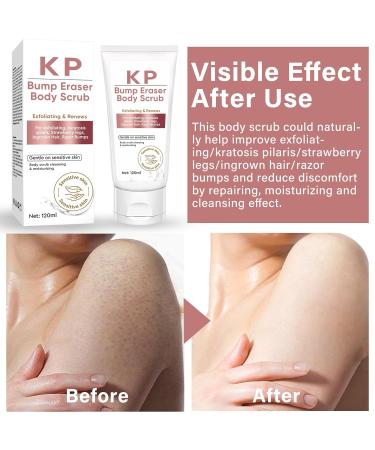 Natural Exfoliating Body Scrub for Keratosis Pilaris - Skin-Friendly Treatment for Strawberry Legs - Best Body Scrub for Women - Buy Online on SooperMarket.com