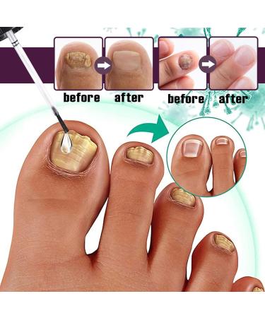 Fungal Nail Treatment 30ml Extra Strong Nail Fungus Treatment for Toenail and Fingernail Premium Fungal Nail Eliminator Anti fungus Nail Repair and Strengthen Fix & Renew Damaged Broken Nails - Buy Online on SooperMarket.com