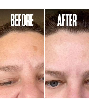 Dark Spot Corrector Serum - Remove Stubborn Dark Spots with Kojic Acid & Alpha Arbutin | Brightening Discoloration Remover for Face - Buy Online on SooperMarket.com