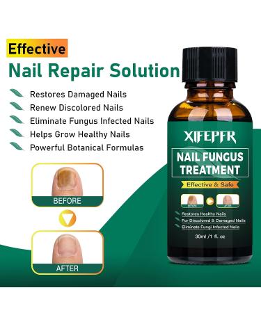 XIFEPFR Toenail Repair Treatment - Extra Strength Nail Renewal Solution for Thick, Brittle, and Discolored Nails - Buy Online on SooperMarket.com