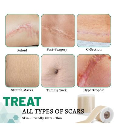 3 Rolls Silicone Scar Sheets(1.6" x 60" Each) Silicone Patches for Scars Reusable Scar Removal Strips for Prevention and Repair - Buy Online on SooperMarket.com