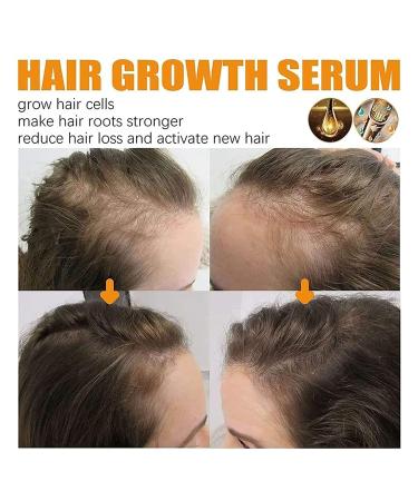 2023 New Allurium Hair Growth Serum for Black Women - Set of 3 Bottles | Anti Hair Loss, Nourishing & Repairing Formula for Fast, Natural Growth - Buy Online on SooperMarket.com