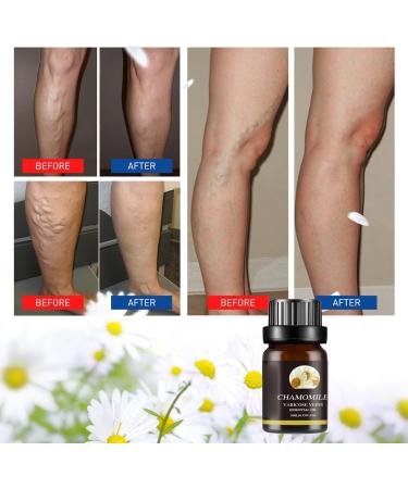 Marronie Oil for Varicose Veins Marronie Chamomile Essential Oil for Varicose Veins 1/3/5 Pack Marronie Oil Varicose Veins (3pcs) - Buy Online on SooperMarket.com