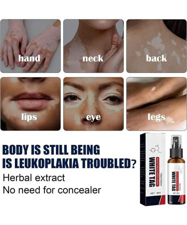 Kolmax Psoriasis Relief Spray - Dermax Treatment, Soothing Coal Tar Cream (3Pcs) - Buy Online on SooperMarket.com