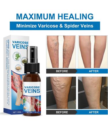 Varicose Veins Miracle Spray: Treatment for Legs to Improve Blood Circulation, Soothe Spider Veins and Relieve Tiredness - Buy Online on SooperMarket.com