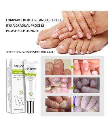 Yueci Hand and Foot Care Cream - Heal & Repair Damaged Nails | Nail Treatment for Cracked & Split Toes - Buy Online on SooperMarket.com